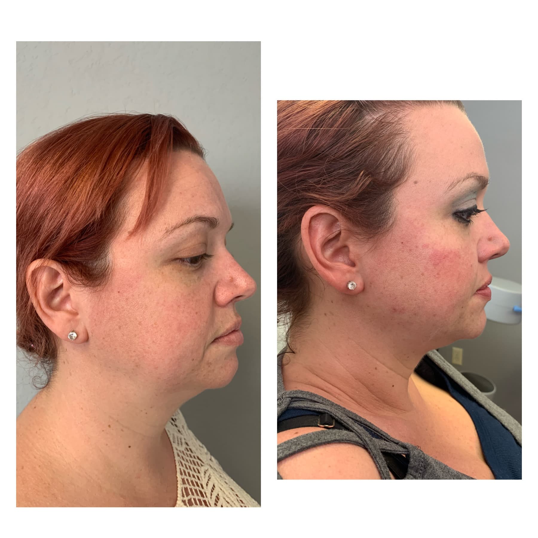 Before and after, real patient at Padgett Medical Center. Individual results vary.