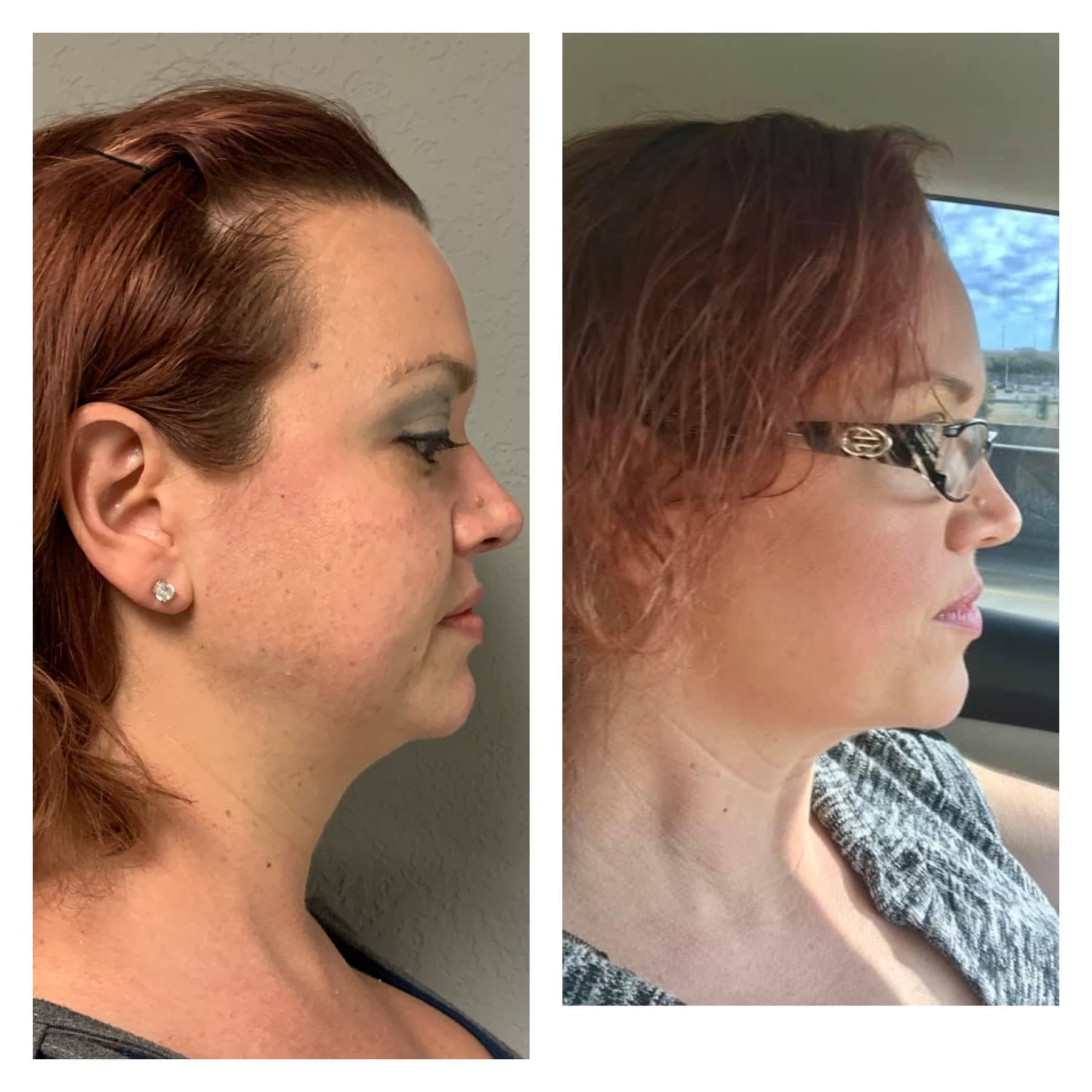 Before and after, real patient at Padgett Medical Center. Individual results vary.