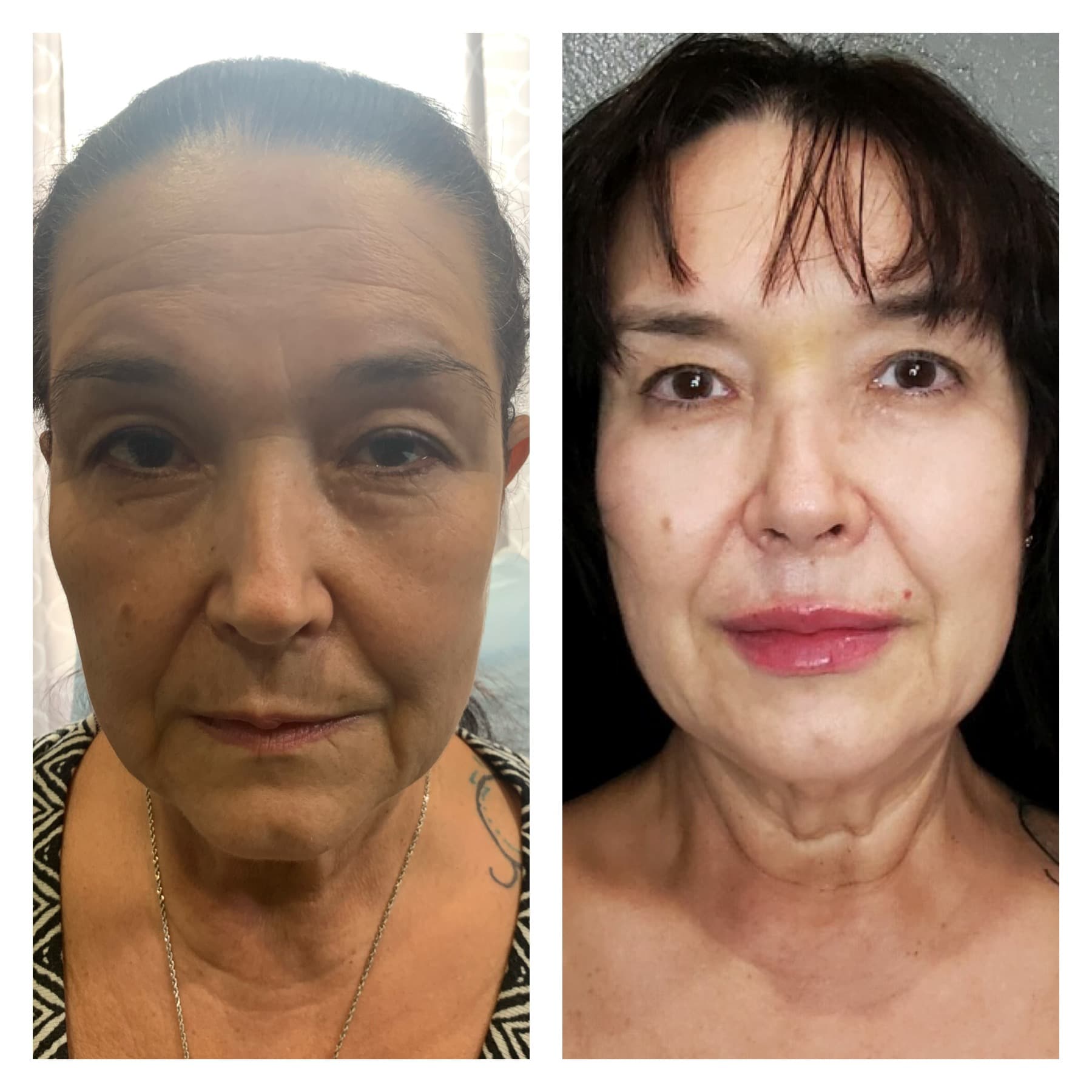 Before and after, real patient at Padgett Medical Center. Individual results vary.
