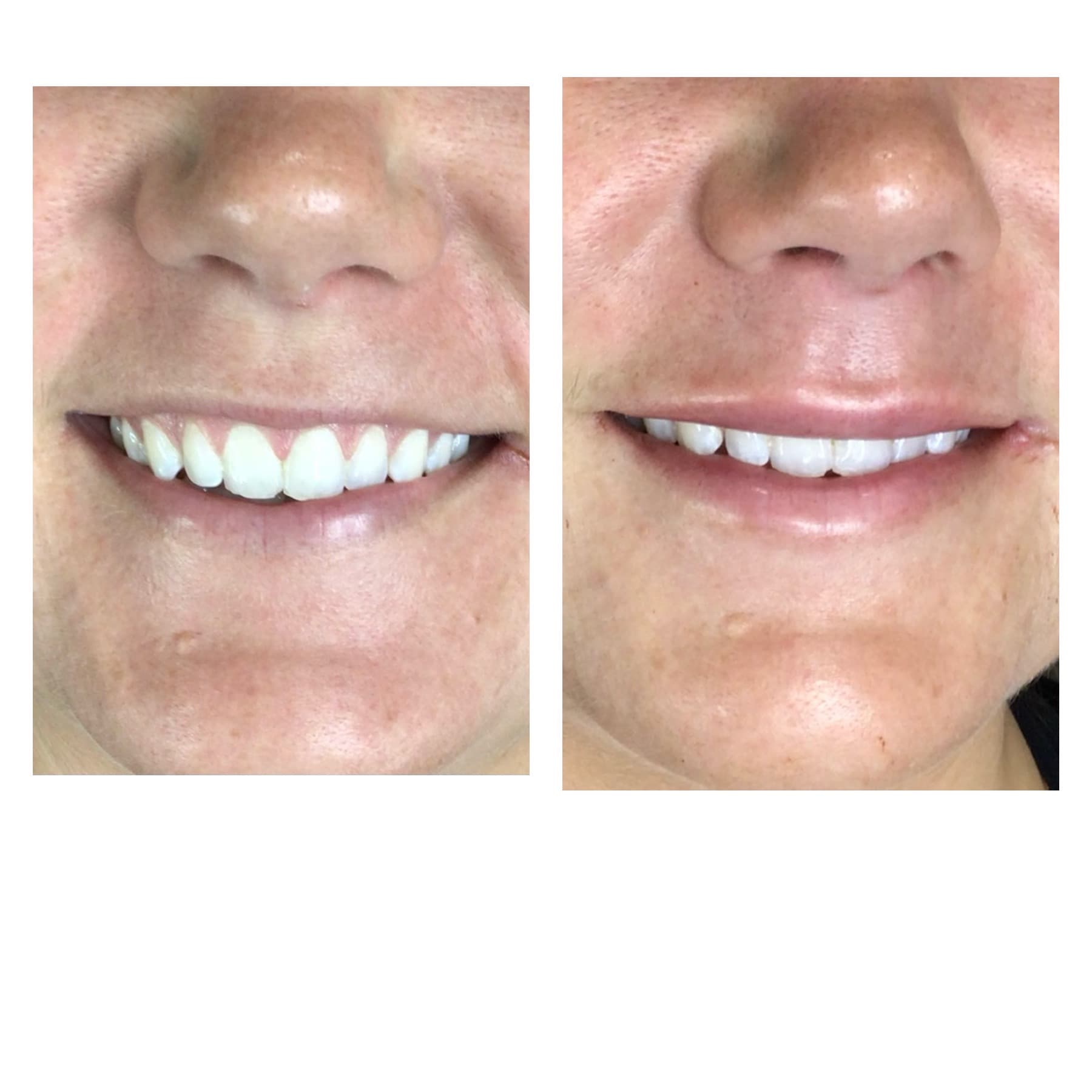 Before and after, real patient at Padgett Medical Center. Individual results vary.