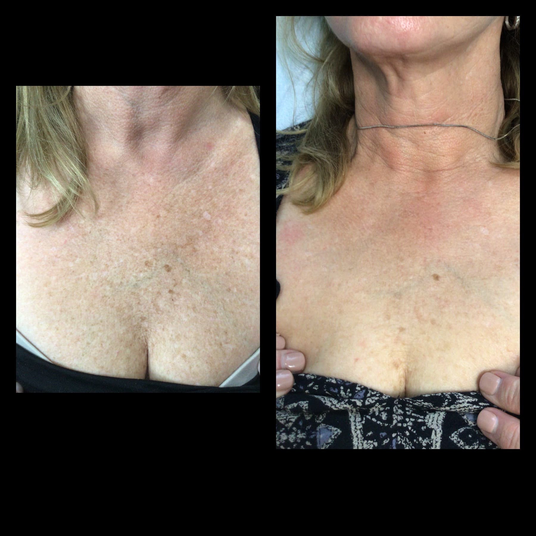 Before and after, real patient at Padgett Medical Center. Individual results vary.
