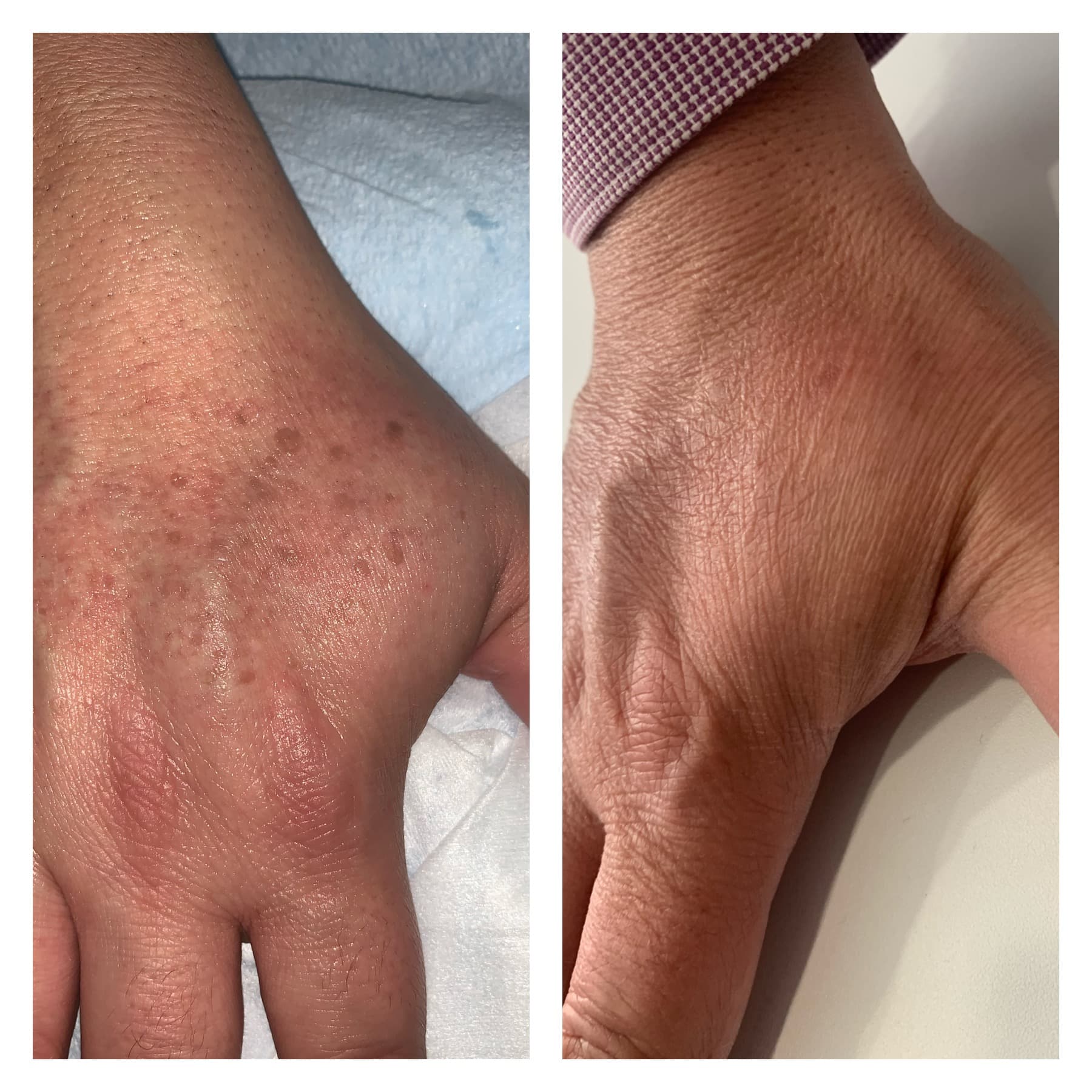 Before and after, real patient at Padgett Medical Center. Individual results vary.