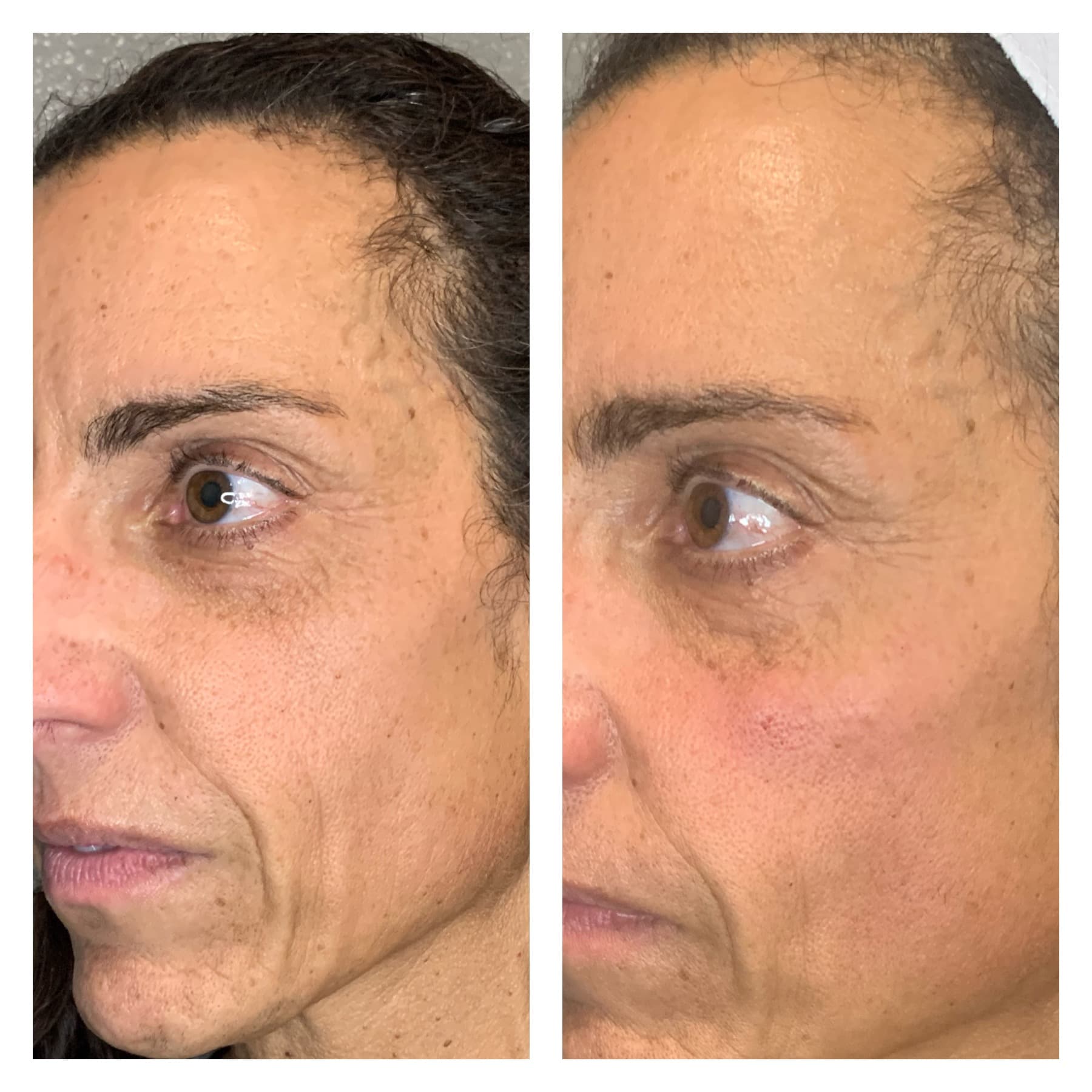 Before and after, real patient at Padgett Medical Center. Individual results vary.