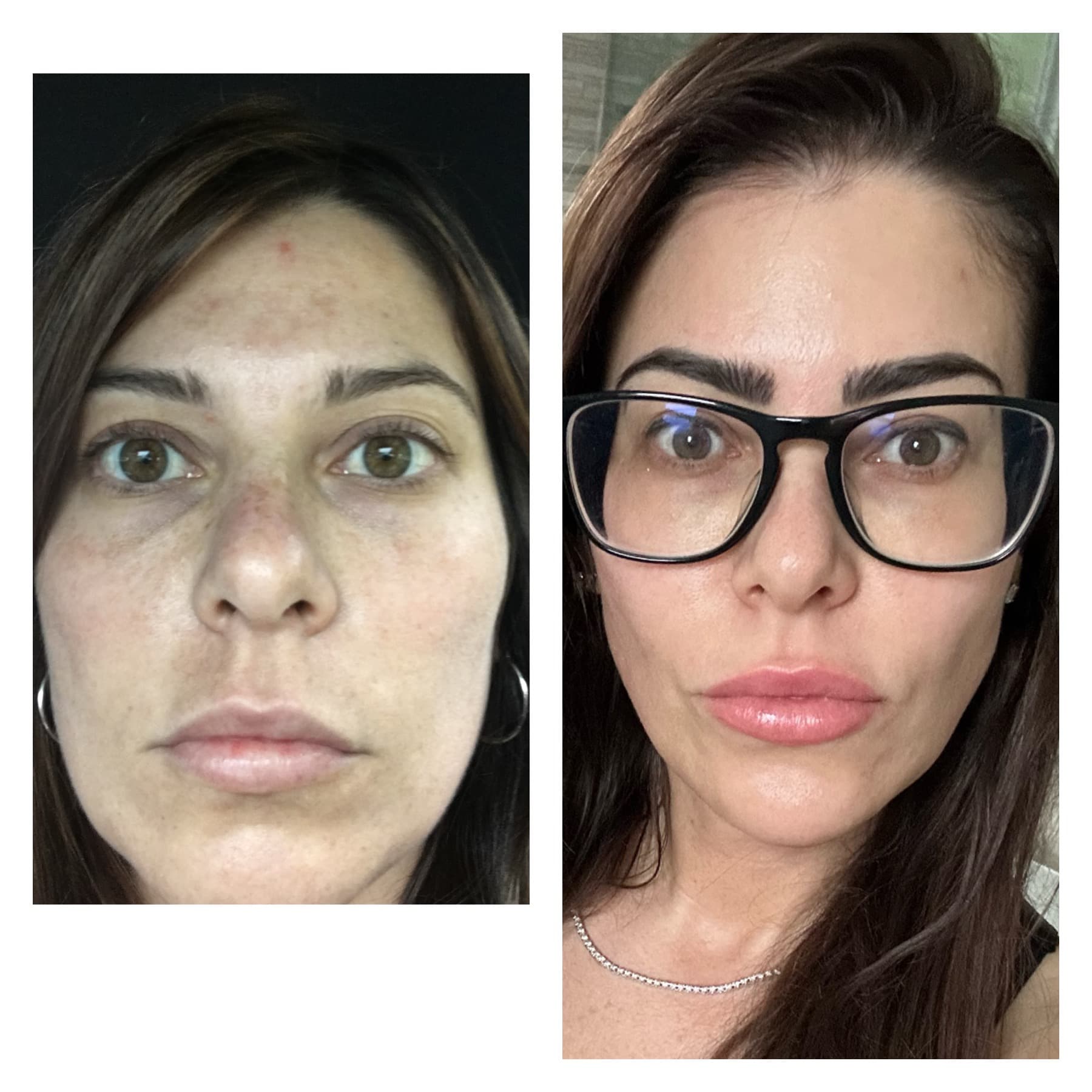 Before and after, real patient at Padgett Medical Center. Individual results vary.
