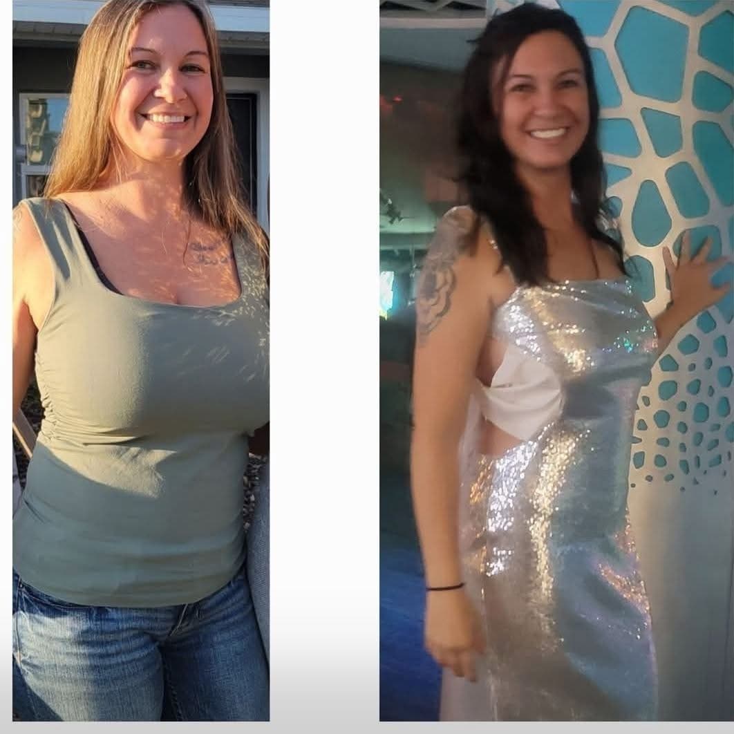 Before and after, real patient at Padgett Medical Center. Individual results vary.